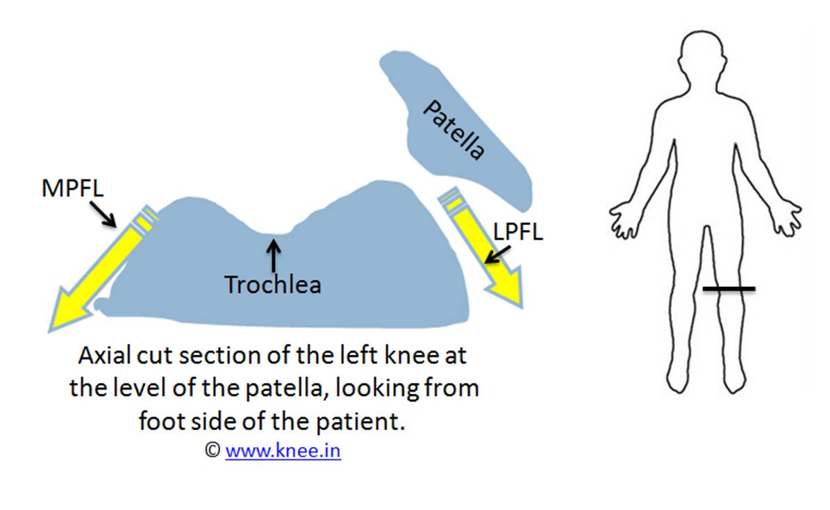 Patella dislocates from the trochlea slot by Dr Deepak Goyal