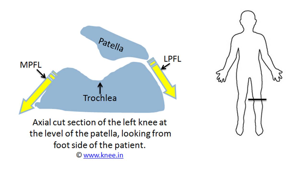 A torn MPFL causes patella to slip out of trochlea slot by Dr Deepak Goyal